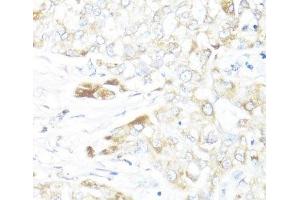 Immunohistochemistry of paraffin-embedded Human liver cancer using HSD17B10 Polyclonal Antibody at dilution of 1:100 (40x lens).
