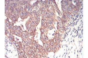 Immunohistochemical analysis of paraffin-embedded ovarian cancer tissues using EMD mouse mAb with DAB staining. (Emerin anticorps  (AA 1-222))