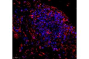 Immunofluorescence of paraffin embedded human lung cancer using C1orf173 (ABIN7074073) at dilution of 1: 150 (450x lens) (Glutamate-Rich Protein 3 (ERICH3) anticorps)
