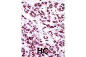 Formalin-fixed and paraffin-embedded human hepatocellular carcinoma tissue reacted with PRKCE polyclonal antibody  , which was peroxidase-conjugated to the secondary antibody, followed by AEC staining . (PKC epsilon anticorps  (AA 213-243))