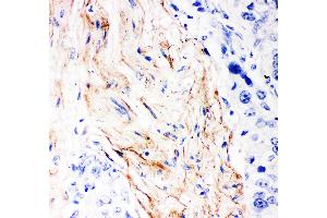 Anti- Decorin Picoband antibody, IHC(P) IHC(P): Human Mammary Cancer Tissue (Decorin anticorps  (AA 31-359))