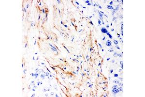 Anti- Decorin Picoband antibody, IHC(P) IHC(P): Human Mammary Cancer Tissue