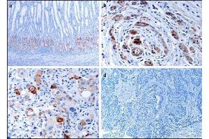 Immunohistochemical analysis of EphB1 in gastric cancer tissues. (EPH Receptor B1 anticorps  (C-Term))