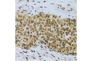 Immunohistochemistry of paraffin-embedded human esophageal cancer using ELAVL1 Antibody.