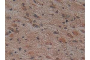 Detection of NOG in Human Glioma Tissue using Monoclonal Antibody to Noggin (NOG)