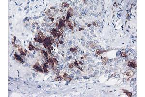 Immunohistochemical staining of paraffin-embedded Adenocarcinoma of Human breast tissue using anti-SERPINB2 mouse monoclonal antibody. (SERPINB2 anticorps)