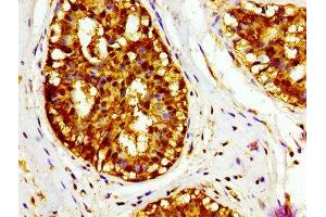 IHC image of ABIN7158882 diluted at 1:400 and staining in paraffin-embedded human breast cancer performed on a Leica BondTM system.