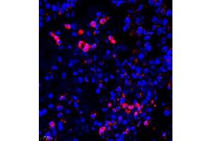 Immunofluorescence of paraffin embedded human lung cancer using UBE3A (ABIN7076105) at dilution of 1:650 (400x lens) (ube3a anticorps)