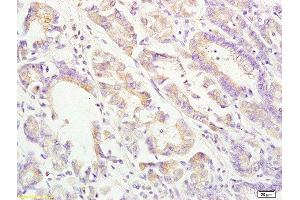 Formalin-fixed and paraffin embedded human gastric carcinoma labeled with Rabbit Anti ApoA4 Polyclonal Antibody, Unconjugated  at 1:200 followed by conjugation to the secondary antibody and DAB staining (APOA4 anticorps  (AA 21-120))