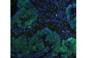 IF analysis of TPR using anti-TPR antibody (ABIN5693275) TPR was detected in paraffin-embedded section of human intestinal cancer tissues. (TPR anticorps)