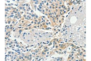 The image on the left is immunohistochemistry of paraffin-embedded Human breast cancer tissue using ABIN7190467(DGKB Antibody) at dilution 1/60, on the right is treated with synthetic peptide. (DGKB anticorps)