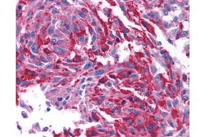 Anti-CRFR1 / CRHR1 antibody IHC of human Skin, Melanoma.