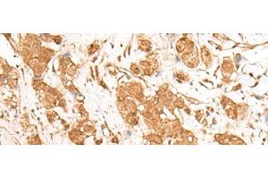 Immunohistochemistry of paraffin-embedded Human breast cancer tissue using GANC Polyclonal Antibody at dilution of 1:55(x200) (GANC anticorps)