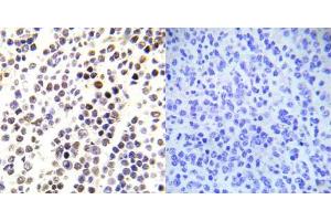 Immunohistochemical analysis of paraffin-embedded human malignant lymphoma tissue using Histone H3. (Histone H3.1 anticorps  (pSer28))