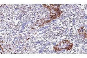 ABIN6266643 at 1/100 staining Human urothelial cancer tissue by IHC-P.