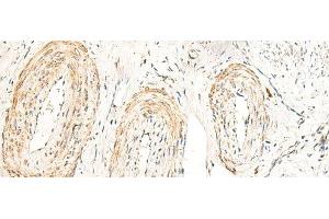 Immunohistochemistry of paraffin-embedded Human cervical cancer tissue using GPR160 Polyclonal Antibody at dilution of 1:35(x200) (GPR160 anticorps)