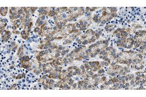 ABIN6275017 at 1/100 staining Human liver cancer tissue by IHC-P. (Claudin 6 anticorps  (Internal Region))