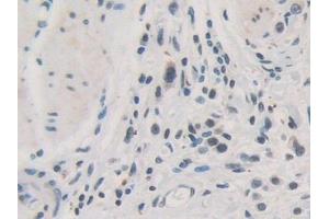 Detection of TOR1A in Human Stomach cancer Tissue using Polyclonal Antibody to Torsin 1A (TOR1A)
