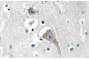 Immunohistochemistry (IHC) analyzes of CaMKIIalpha/delta antibody in paraffin-embedded human breast carcinoma tissue. (CAMK2A anticorps)