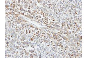 IHC-P Image Immunohistochemical analysis of paraffin-embedded human glioma, using HSP70 1B, antibody at 1:100 dilution.