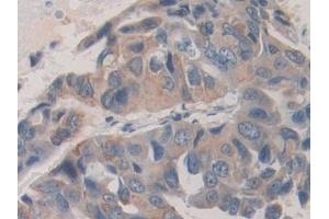 Detection of SHC3 in Human Breast cancer Tissue using Polyclonal Antibody to SHC-Transforming Protein 3 (SHC3)