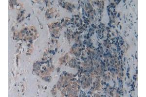 Detection of LPCAT3 in Human Breast cancer Tissue using Polyclonal Antibody to Lysophosphatidylcholine Acyltransferase 3 (LPCAT3)