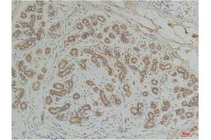 Immunohistochemistry (IHC) analysis of paraffin-embedded Human Breast Carcinoma using EphA1 Rabbit Polyclonal Antibody diluted at 1:200. (EPHA1 anticorps)