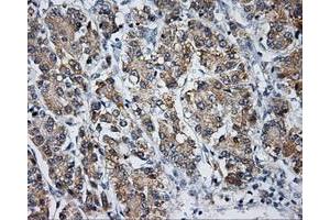 Immunohistochemical staining of paraffin-embedded Carcinoma of liver tissue using anti-LIPG mouse monoclonal antibody. (LIPG anticorps)