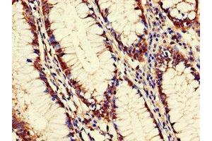 Immunohistochemistry of paraffin-embedded human colon cancer using ABIN7162603 at dilution of 1:100