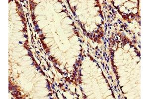 Immunohistochemistry of paraffin-embedded human colon cancer using ABIN7162603 at dilution of 1:100 (PANK2 anticorps  (AA 437-490))