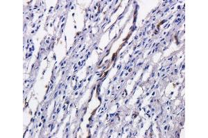 Immunohistochemical staining of human ovarian cancer using anti-TAG72 antibody  Formalin fixed human ovarian cancer slices were were stained with  at 5 µg/ml. (Recombinant TAG-72 (Satumomab Biosimilar) anticorps)