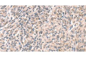 Immunohistochemistry of paraffin-embedded Human prostate cancer using DECR1 Polyclonal Antibody at dilution of 1:50 (DECR1 anticorps)