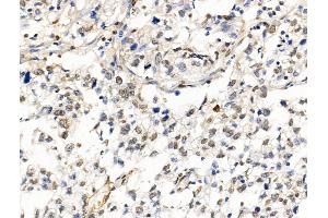 ABIN6262190 and ABIN6269019 at 1/100 staining Human pancreatic cancer by IHC-P. (HDAC7 anticorps  (C-Term))