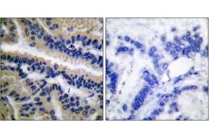 Immunohistochemistry analysis of paraffin-embedded human lung carcinoma tissue, using Caspase 9 (Cleaved-Asp353) Antibody. (Caspase 9 anticorps  (Cleaved-Asp353))