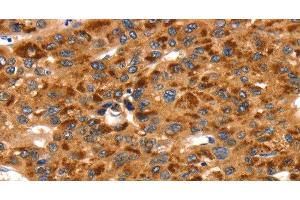 Immunohistochemistry of paraffin-embedded Human liver cancer using TLN1 Polyclonal Antibody at dilution of 1:35