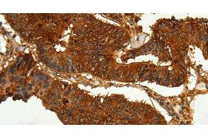 Immunohistochemistry of paraffin-embedded Human colon cancer tissue using CEACAM21 Polyclonal Antibody at dilution 1:60 (CEACAM21 anticorps)