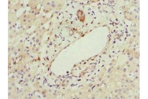 Immunohistochemistry of paraffin-embedded human liver cancer using ABIN7167073 at dilution of 1:100 (HBXIP anticorps  (AA 1-91))