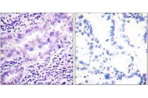 Immunohistochemistry analysis of paraffin-embedded human lung carcinoma, using PP2A-alpha (Phospho-Tyr307) Antibody. (PPP2CA anticorps  (pTyr307))