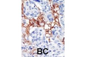 Formalin-fixed and paraffin-embedded human cancer tissue reacted with the primary antibody, which was peroxidase-conjugated to the secondary antibody, followed by AEC staining.