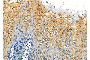 ABIN6262909 and ABIN6273260 at 1/100 staining Human esophageal cancer and adjacent normal tissues by IHC-P. (LAPTM4B anticorps  (Internal Region))