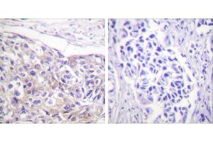 Immunohistochemistry analysis of paraffin-embedded human breast carcinoma tissue using p90 RSK (Phospho-Thr573) antibody.