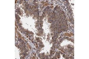 Immunohistochemical staining of human prostate with KIAA1609 polyclonal antibody  shows moderate cytoplasmic positivity in glandular cells at 1:500-1:1000 dilution. (KIAA1609 anticorps)