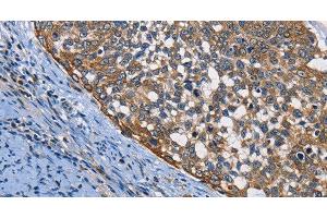 Immunohistochemistry of paraffin-embedded Human cervical cancer using PGK1 Polyclonal Antibody at dilution of 1:50