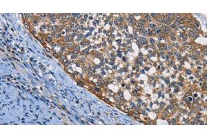 Immunohistochemistry of paraffin-embedded Human cervical cancer using PGK1 Polyclonal Antibody at dilution of 1:50 (PGK1 anticorps)