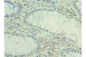Immunohistochemistry of paraffin-embedded human colon cancer using ABIN7156908 at dilution of 1:100 (FIL1d anticorps  (AA 1-155))