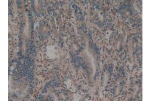 IHC-P analysis of Human Stomach Cancer Tissue, with DAB staining. (CALU anticorps  (AA 20-315))