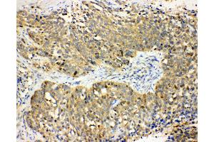 Anti-Haptoglobin antibody, IHC(P) IHC(P): Human Lung Cancer Tissue