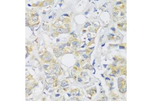 Immunohistochemistry of paraffin-embedded human breast cancer using Snail antibody (ABIN6132675, ABIN6148177, ABIN6148180 and ABIN6221190) at dilution of 1:100 (40x lens).