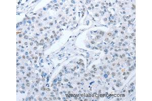 Immunohistochemistry of Human lung cancer using ARHGEF2 Polyclonal Antibody at dilution of 1:30 (ARHGEF2 anticorps)