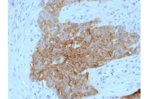 Formalin-fixed, paraffin-embedded human Tongue stained with GLUT-1 Mouse Monoclonal Antibody (GLUT1/2475).